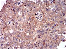 DIS3L2 Antibody - IHC of paraffin-embedded endometrial cancer tissues using DIS3L2 mouse monoclonal antibody with DAB staining.