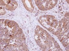 DIS3L2 Antibody - IHC of paraffin-embedded Colon ca, using DIS3L2 antibody at 1:500 dilution.