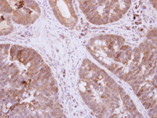 DIS3L2 Antibody - IHC of paraffin-embedded Colon ca, using DIS3L2 antibody at 1:500 dilution.