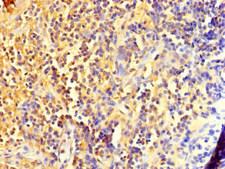 DIS3L2 Antibody - Immunohistochemistry of paraffin-embedded human bladder cancer using DIS3L2 Antibody at dilution of 1:100