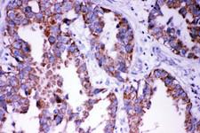 DISC1 Antibody - DISC1 antibody IHC-paraffin: Human Lung Cancer Tissue.