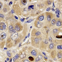 DISC1 Antibody - Immunohistochemical analysis of DISC-1 staining in human liver cancer formalin fixed paraffin embedded tissue section. The section was pre-treated using heat mediated antigen retrieval with sodium citrate buffer (pH 6.0). The section was then incubated with the antibody at room temperature and detected using an HRP conjugated compact polymer system. DAB was used as the chromogen. The section was then counterstained with hematoxylin and mounted with DPX.