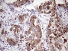 DJ858B16.2 / PISD Antibody - Immunohistochemical staining of paraffin-embedded Adenocarcinoma of Human endometrium tissue using anti-PISD mouse monoclonal antibody. (Heat-induced epitope retrieval by 1mM EDTA in 10mM Tris buffer. (pH8.5) at 120 oC for 3 min. (1:150)