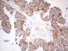 DJ858B16.2 / PISD Antibody - Immunohistochemical staining of paraffin-embedded Adenocarcinoma of Human ovary tissue using anti-PISD mouse monoclonal antibody. (Heat-induced epitope retrieval by 1mM EDTA in 10mM Tris buffer. (pH8.5) at 120°C for 3 min. (1:150)