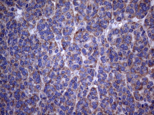 DJ858B16.2 / PISD Antibody - Immunohistochemical staining of paraffin-embedded Carcinoma of Human thyroid tissue using anti-PISD mouse monoclonal antibody. (Heat-induced epitope retrieval by 1mM EDTA in 10mM Tris buffer. (pH8.5) at 120°C for 3 min. (1:150)