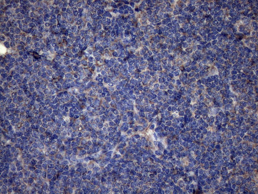 DJ858B16.2 / PISD Antibody - Immunohistochemical staining of paraffin-embedded Human lymphoma tissue using anti-PISD mouse monoclonal antibody. (Heat-induced epitope retrieval by 1mM EDTA in 10mM Tris buffer. (pH8.5) at 120°C for 3 min. (1:150)
