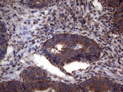 DJ858B16.2 / PISD Antibody - Immunohistochemical staining of paraffin-embedded Adenocarcinoma of Human colon tissue using anti-PISD mouse monoclonal antibody. (Heat-induced epitope retrieval by 1mM EDTA in 10mM Tris buffer. (pH8.5) at 120°C for 3 min. (1:150)