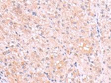 DJ858B16.2 / PISD Antibody - Immunohistochemistry of paraffin-embedded Human liver cancer tissue  using PISD Polyclonal Antibody at dilution of 1:80(×200)