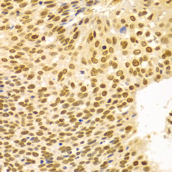 DKC1 / Dyskerin Antibody - Immunohistochemistry of paraffin-embedded human esophageal cancer tissue.