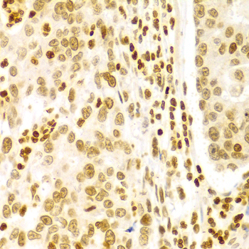 DKC1 / Dyskerin Antibody - Immunohistochemistry of paraffin-embedded Human gastric cancer tissue.