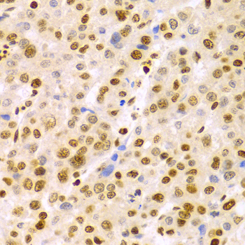 DKC1 / Dyskerin Antibody - Immunohistochemistry of paraffin-embedded liver cancer tissue.