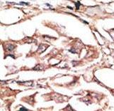 DKK2 Antibody - Formalin-fixed and paraffin-embedded human cancer tissue reacted with the primary antibody, which was peroxidase-conjugated to the secondary antibody, followed by AEC staining. This data demonstrates the use of this antibody for immunohistochemistry; clinical relevance has not been evaluated. BC = breast carcinoma; HC = hepatocarcinoma.