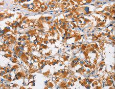 DKK3 Antibody - Immunohistochemistry of paraffin-embedded Human thyroid cancer using DKK3 Polyclonal Antibody at dilution of 1:50.