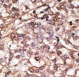 DKK4 Antibody - Formalin-fixed and paraffin-embedded human cancer tissue reacted with the primary antibody, which was peroxidase-conjugated to the secondary antibody, followed by DAB staining. This data demonstrates the use of this antibody for immunohistochemistry; clinical relevance has not been evaluated. BC = breast carcinoma; HC = hepatocarcinoma.