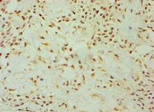 DKK4 Antibody - Immunohistochemistry of paraffin-embedded human breast cancer using antibody at 1:100 dilution.