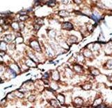 DKKL1 / Soggy-1 Antibody - Formalin-fixed and paraffin-embedded human cancer tissue reacted with the primary antibody, which was peroxidase-conjugated to the secondary antibody, followed by DAB staining. This data demonstrates the use of this antibody for immunohistochemistry; clinical relevance has not been evaluated. BC = breast carcinoma; HC = hepatocarcinoma.