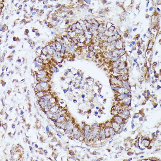 DLAT / PDC-E2 Antibody - Immunohistochemistry of paraffin-embedded Human colon carcinoma using DLAT Polyclonal Antibody at dilution of 1:100 (40x lens).