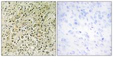 DLC1 Antibody - Immunohistochemistry analysis of paraffin-embedded human prostate carcinoma tissue, using RHG07 Antibody. The picture on the right is blocked with the synthesized peptide.