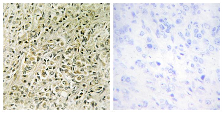 DLC1 Antibody - Peptide - + Immunohistochemistry analysis of paraffin-embedded human prostate carcinoma tissue, using RHG07 antibody.