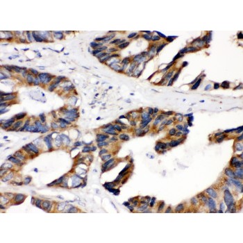 DLD / Diaphorase / E3 Antibody - DLD antibody IHC-paraffin. IHC(P): Human Intestinal Cancer Tissue.