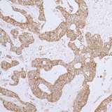 DLD / Diaphorase / E3 Antibody - Detection of human DLD by immunohistochemistry. Sample: FFPE section of human ovarian carcinoma. Antibody: Affinity purified rabbit anti- DLD used at a dilution of 1:1,000 (1µg/ml). Detection: DAB
