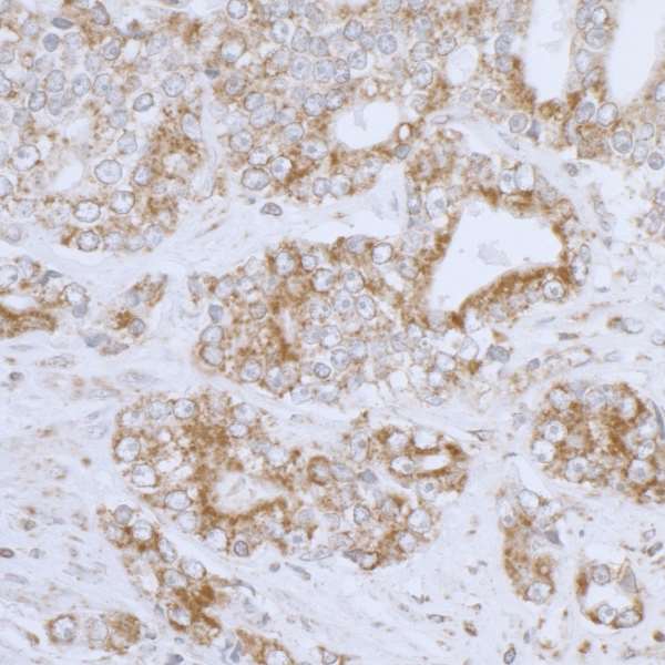 DLD / Diaphorase / E3 Antibody - Detection of human DLD by immunohistochemistry. Sample: FFPE section of human prostate carcinoma. Antibody: Affinity purified rabbit anti- DLD used at a dilution of 1:5,000 (0.2µg/ml). Detection: DAB