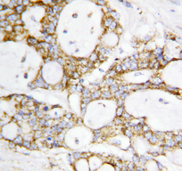 DLD / Diaphorase / E3 Antibody - DLD / Diaphorase / E3 antibody. IHC(P): Human Breast Cancer Tissue.