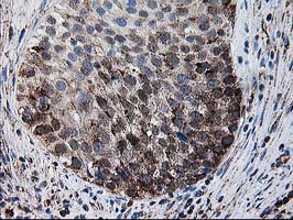 DLD / Diaphorase / E3 Antibody - IHC of paraffin-embedded Carcinoma of Human bladder tissue using anti-DLD mouse monoclonal antibody.