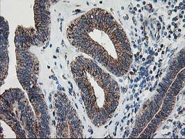 DLD / Diaphorase / E3 Antibody - IHC of paraffin-embedded Adenocarcinoma of Human endometrium tissue using anti-DLD mouse monoclonal antibody.