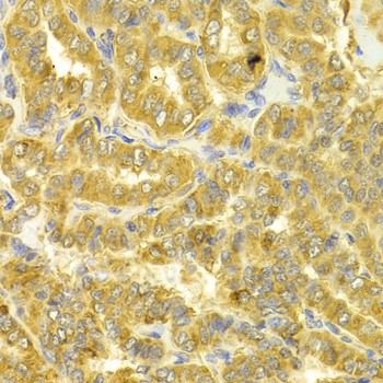 DLD / Diaphorase / E3 Antibody - Immunohistochemistry of paraffin-embedded human thyroid cancer tissue.