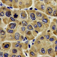DLD / Diaphorase / E3 Antibody - Immunohistochemical analysis of DLD staining in human liver cancer formalin fixed paraffin embedded tissue section. The section was pre-treated using heat mediated antigen retrieval with sodium citrate buffer (pH 6.0). The section was then incubated with the antibody at room temperature and detected using an HRP conjugated compact polymer system. DAB was used as the chromogen. The section was then counterstained with hematoxylin and mounted with DPX.