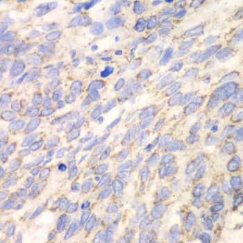 DLD / Diaphorase / E3 Antibody - Immunohistochemistry of paraffin-embedded human esophageal cancer using DLD antibody at dilution of 1:100 (40x lens).