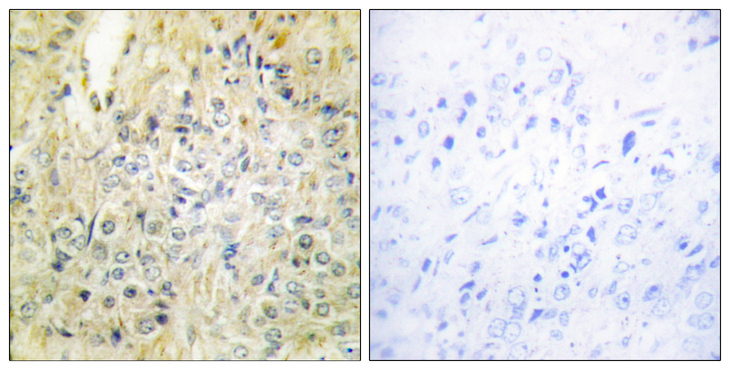 DLEC1 / DLC1 Antibody - Immunohistochemistry analysis of paraffin-embedded human prostate carcinoma tissue, using DLEC1 Antibody. The picture on the right is blocked with the synthesized peptide.