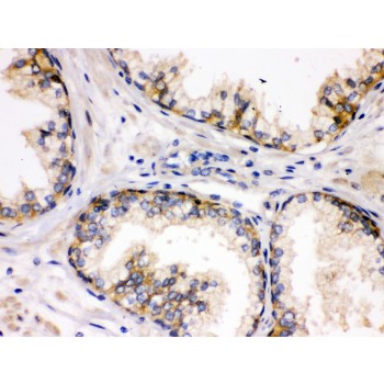 DLG1 / SAP97 Antibody - SAP97 antibody IHC-paraffin. IHC(P): Human Prostatic Cancer Tissue.