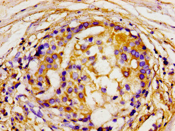 DLG2 / PSD93 Antibody - Immunohistochemistry image of paraffin-embedded human breast cancer at a dilution of 1:100