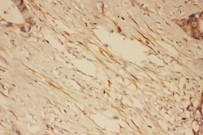 DLG4 / PSD95 Antibody - DLG4 / PSD95 antibody. IHC(P): Human Intestinal Cancer Tissue.