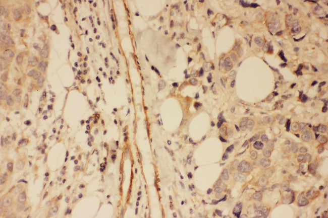 DLG4 / PSD95 Antibody - DLG4 / PSD95 antibody. IHC(P): Human Breast Cancer Tissue.