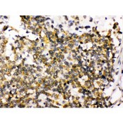 DLG4 / PSD95 Antibody - PSD95 antibody IHC-paraffin. IHC(P): Human Glioma Tissue.