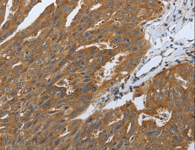 DLG4 / PSD95 Antibody - Immunohistochemistry of paraffin-embedded Human ovarian cancer using DLG4 Polyclonal Antibody at dilution of 1:40.