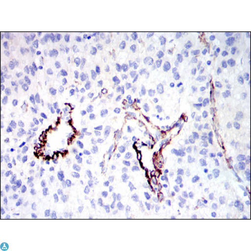 DLGAP1 Antibody - Immunohistochemistry (IHC) analysis of paraffin-embedded Human Liver Cancer Tissues with DAB staining using SAPAP1 Monoclonal Antibody.