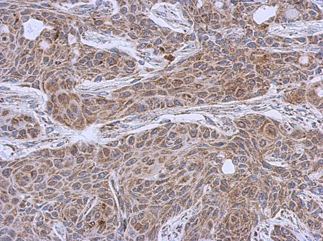 DLST / E2 Antibody - IHC of paraffin-embedded Cal27 xenograft using DLST antibody at 1:500 dilution.