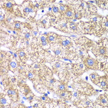DLST / E2 Antibody - Immunohistochemistry of paraffin-embedded human liver injury tissue.