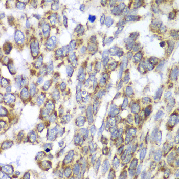 DLST / E2 Antibody - Immunohistochemistry of paraffin-embedded human esophageal cancer tissue.