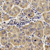 DLST / E2 Antibody - Immunohistochemical analysis of DLST staining in human liver cancer formalin fixed paraffin embedded tissue section. The section was pre-treated using heat mediated antigen retrieval with sodium citrate buffer (pH 6.0). The section was then incubated with the antibody at room temperature and detected using an HRP conjugated compact polymer system. DAB was used as the chromogen. The section was then counterstained with hematoxylin and mounted with DPX.