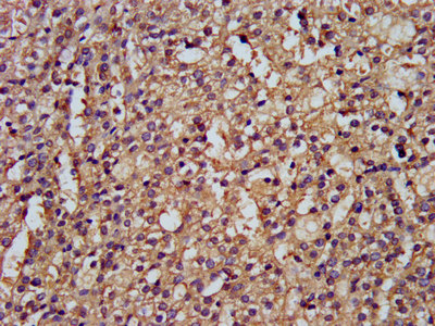 DLST / E2 Antibody - Immunohistochemistry image at a dilution of 1:300 and staining in paraffin-embedded human adrenal gland tissue performed on a Leica BondTM system. After dewaxing and hydration, antigen retrieval was mediated by high pressure in a citrate buffer (pH 6.0) . Section was blocked with 10% normal goat serum 30min at RT. Then primary antibody (1% BSA) was incubated at 4 °C overnight. The primary is detected by a biotinylated secondary antibody and visualized using an HRP conjugated SP system.