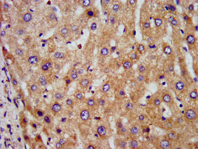 DLST / E2 Antibody - Immunohistochemistry image at a dilution of 1:300 and staining in paraffin-embedded human liver tissue performed on a Leica BondTM system. After dewaxing and hydration, antigen retrieval was mediated by high pressure in a citrate buffer (pH 6.0) . Section was blocked with 10% normal goat serum 30min at RT. Then primary antibody (1% BSA) was incubated at 4 °C overnight. The primary is detected by a biotinylated secondary antibody and visualized using an HRP conjugated SP system.