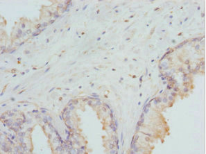 DLX2 Antibody - Immunohistochemistry of paraffin-embedded human prostate cancer at dilution 1:100