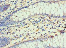 DLX3 Antibody - Immunohistochemistry of paraffin-embedded human colon cancer using antibody at 1:100 dilution.