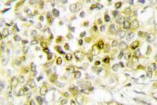 DLX5 Antibody - IHC of Dlx-5 (E126) pAb in paraffin-embedded human lung carcinoma tissue.