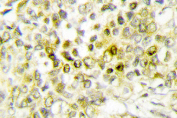 DLX5 Antibody - IHC of Dlx-5 (E126) pAb in paraffin-embedded human lung carcinoma tissue.